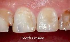Tooth (dental) erosion