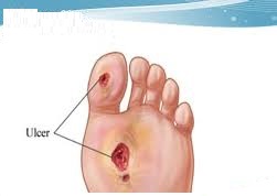 مراقبت پاها در دیابت